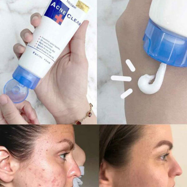 Mistine Acne Clear Facial Foam – Oil Control & Acne Scar Cleanser (Suitable for Acne-Prone Skin) - Image 9