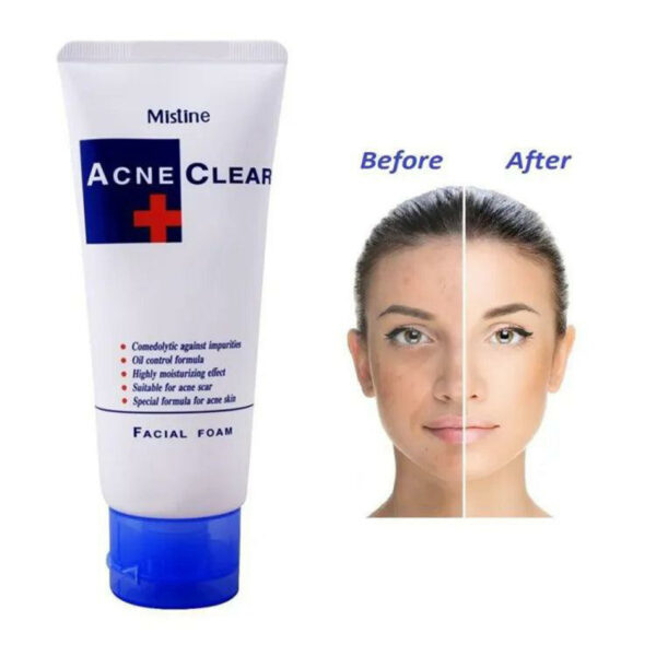 Mistine Acne Clear Facial Foam – Oil Control & Acne Scar Cleanser (Suitable for Acne-Prone Skin) - Image 15